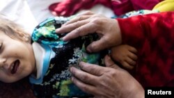 یکی از اطفال مبتلا به سؤء تغذی 