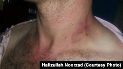 نشانه های از ضرب و شتم در وجود یک خبرنگار افغان