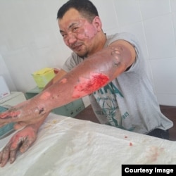 ЖЭБдеги кырсыктан жараат алган Чыңгыз Бактыбеков.