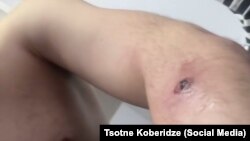 Повреждение, которое получил Цотне Коберидзе