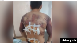 Подвергшийся пыткам после задержания в январе житель Алматинской области Азамат Батырбаев