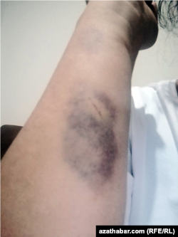 В результате полученных травм, на теле Дурсолтан Тагановой образовались гемотомы. 16 августа 2022 г.