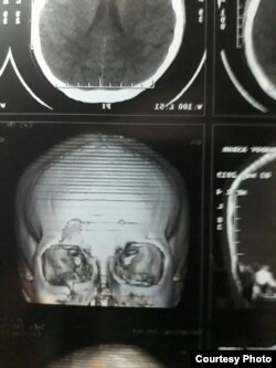 Sinfdoshi tomonidan kaltaklangan Asror Toshmurodovning bosh chanog‘i shikastlanganiga oid rentgen surat