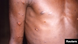 Маймыл чечеги вирусун жуктурган адамдын денеси.