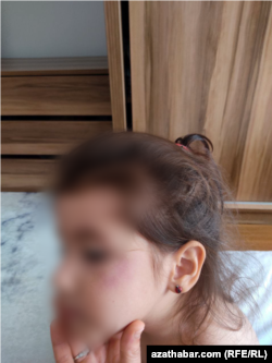 Ранение в глаз получила 4-летняя дочь Зарины Ахтямовой Эмина. 17 августа 2022 г.