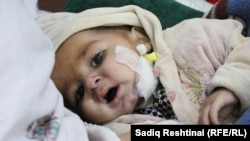 یک کودک مبتلا به سوء تغذیه در افغانستان