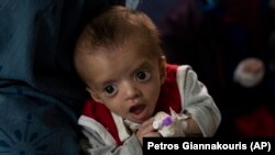 کودک مبتلا به سؤ تغذیه 