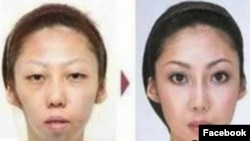 ХIусамнана, пластикан операци яле а, йинчул тIаьхьа а.