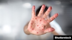 Generic -- Viral Diseases - Hand Infected - Hand foot and mouth disease HFMD