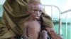 Абдикахин Омар, оказавшийся в госпитале вследствие недоедания. Сомали, 21 июля 2011 года. 