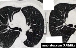 Рентгеновский снимок легких пациента с COVID-19