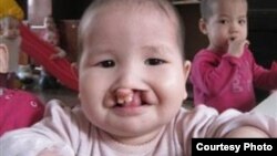 یک کودک مبتلا به لب چاک - عکس از آرشیف