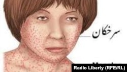 سرخکان به عنوان یک بیماری ساری و قابل گسترش شناخته میشود