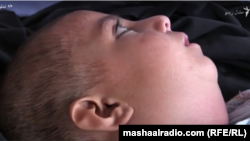 کله چرک یکی از بیماری های ساری که اطفال زیر سن پنج سال را تهدید می‌کند