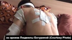 Следы от "расстрела" на одном из "топкинских" ребят