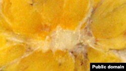 Срез рака груди, раковые клетки похожи на краба. Именно рак груди попытаются вылечить медики новым химиотерапевтическим средством