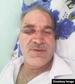 Тоҷири эронӣ мегӯяд, як чашмаш нобино шудааст.