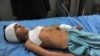 A wounded boy receives treatment at a hospital in Jalalabad after an explosion in the Ghani Khel district of Nangarhar province, which killed at least 14 people. 