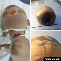 Поранений у голову учасник АТО