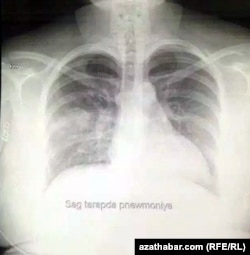 turkmenistan. x-ray of covid patient in ashgaba