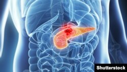 Xərçəng, arxiv fotosu