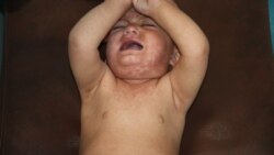 یک کودک مصاب به بیماری سرخکان در ولایت پکتیا