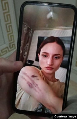 Фотография Айшат Баймурадовой со следами домашнего насилия