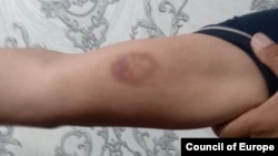 Сирожиддин Курбанов показывает синяк на руке после побоев сотрудниками милиции