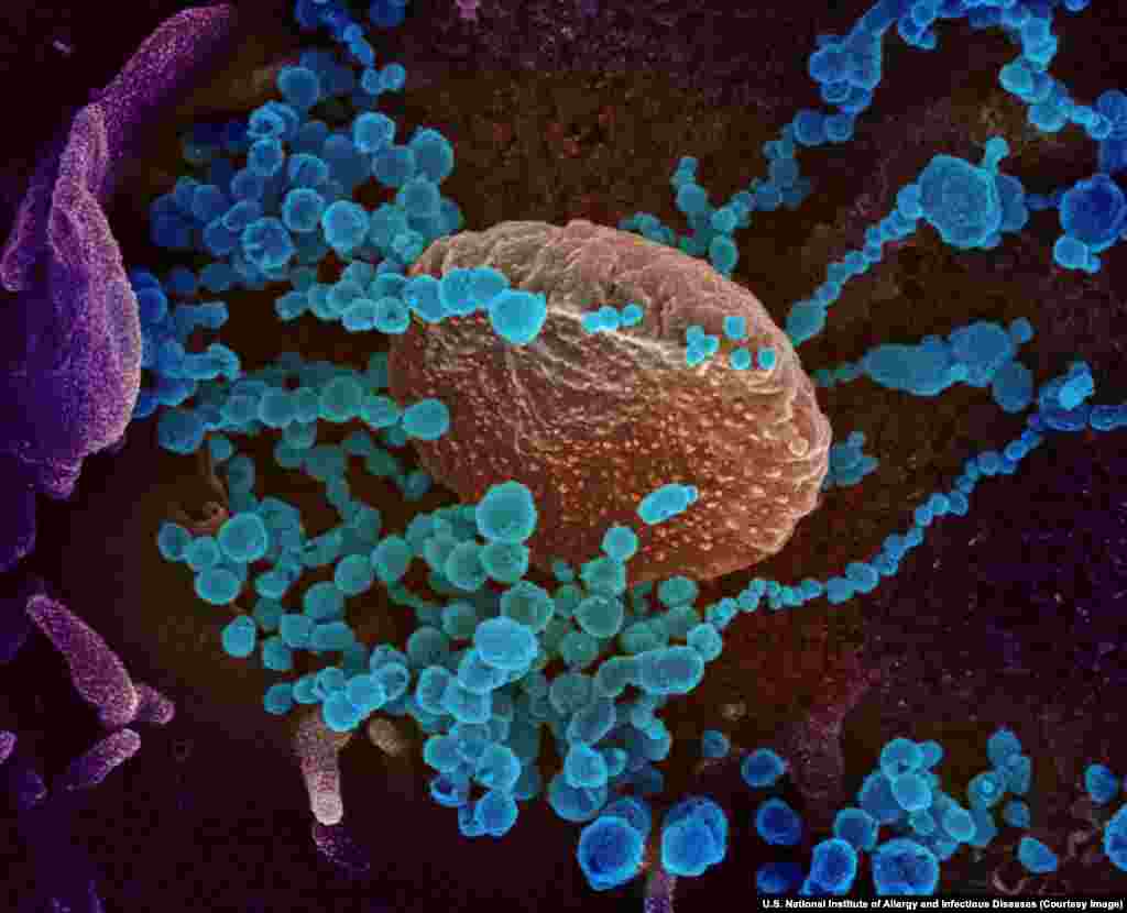 Вирионы SARS-CoV-2, разрастающиеся в клетке человеческого организма. Все фотографии в этой галерее раскрашены с использованием специальных программ, включая Photoshop.